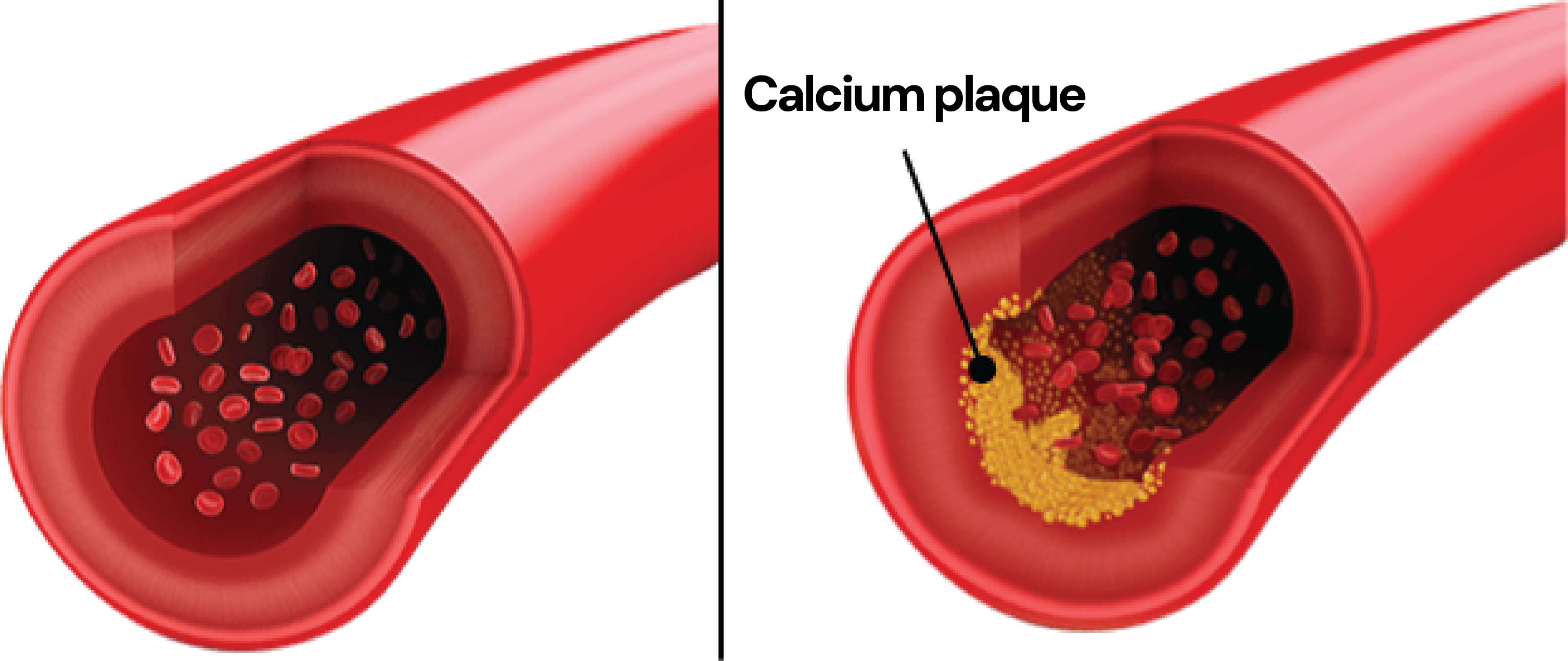 Calcium plaque build-up in arteries